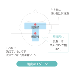 頭皮のTゾーン